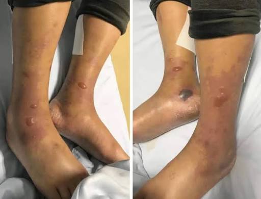 Vibrio vulnificus: Symptoms, Causes, Risk Factors, Treatment and Prevention